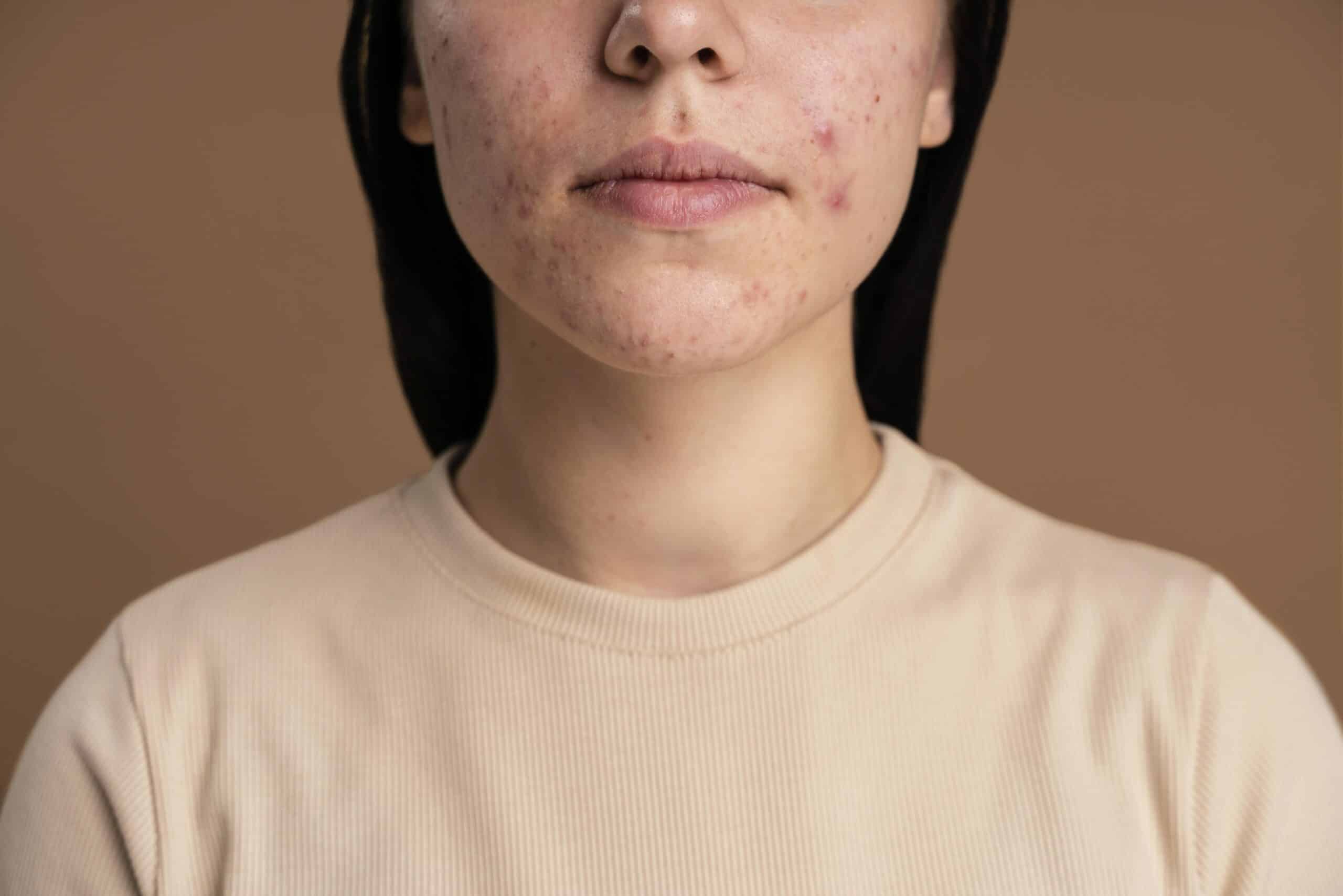 What Causes Acne?